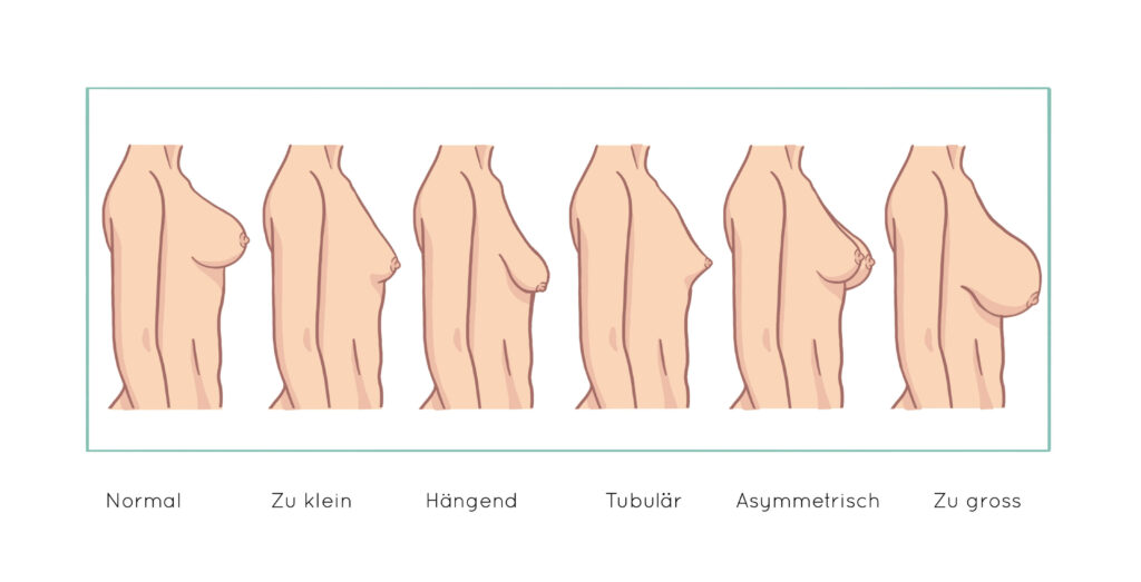 Übersicht der verschiedenen Arten von Brustfehlbildungen