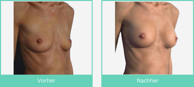 Ergebnis einer Brustvergrößerung von A auf B mit runden Implantaten