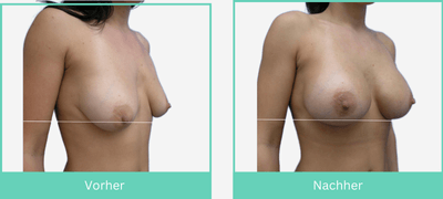 Vorher Nachher einer Brustvergrößerung mit Implantaten wodurch die Brüste gleichzeitig gestrafft wirken