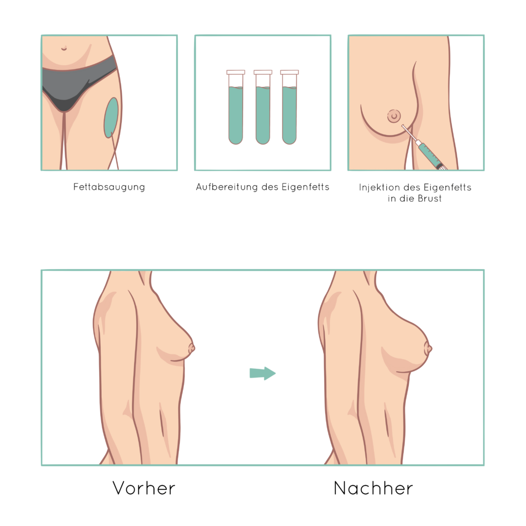Ablauf und Ergebnis der Brustvergrößerung mit Eigenfett