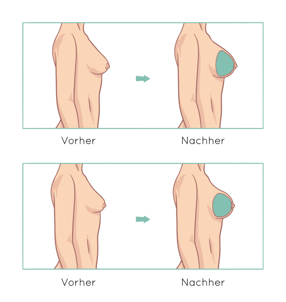 Unterschied einer Brustvergrößerung mit anatomischem sowie rundem Implantat