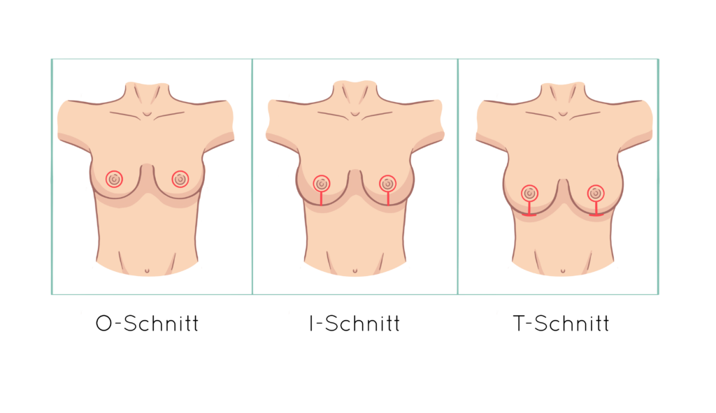Übersicht der Schnitttechniken bei einer Brustverkleinerung