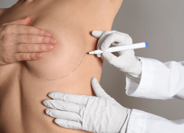 Schnittführung in der Unterbrustfalte bei Brustvergrößerung mit Implantaten